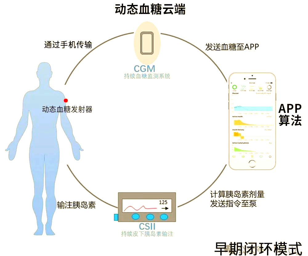 美敦力780g 革命性的閉環式胰島素泵，引領高效、穩定與精確的糖尿病管理